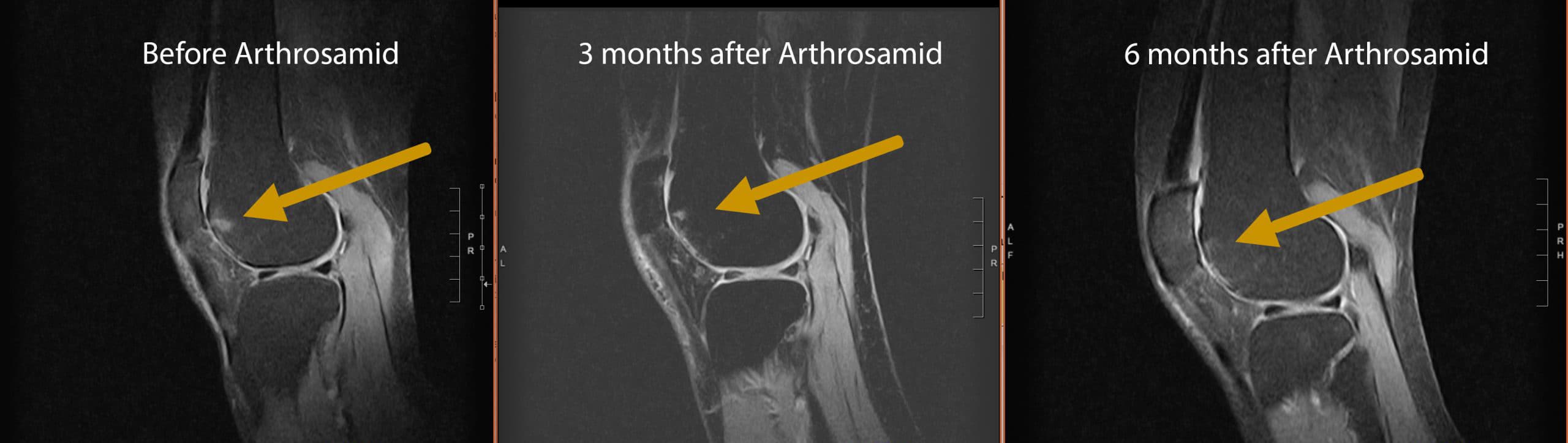 MRI sequence demonstrating knee joint changes over time with Arthrosamid® treatment